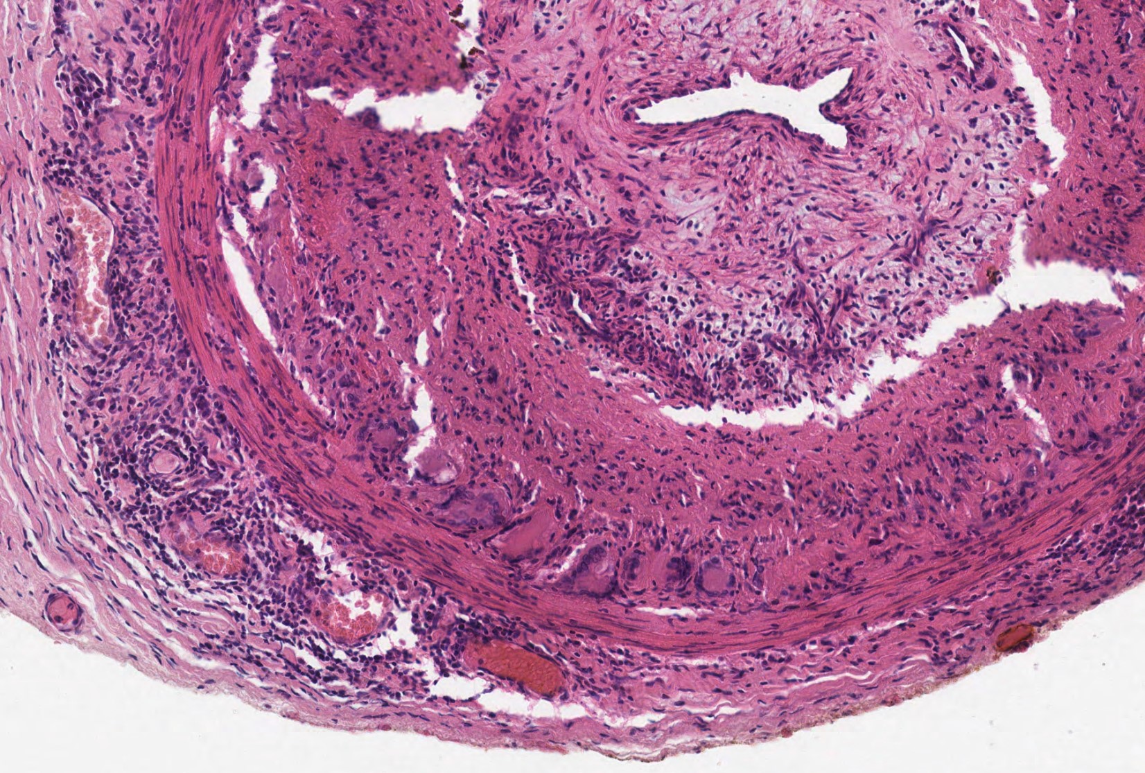 Multinucleated Giant Cells - GCA Histology