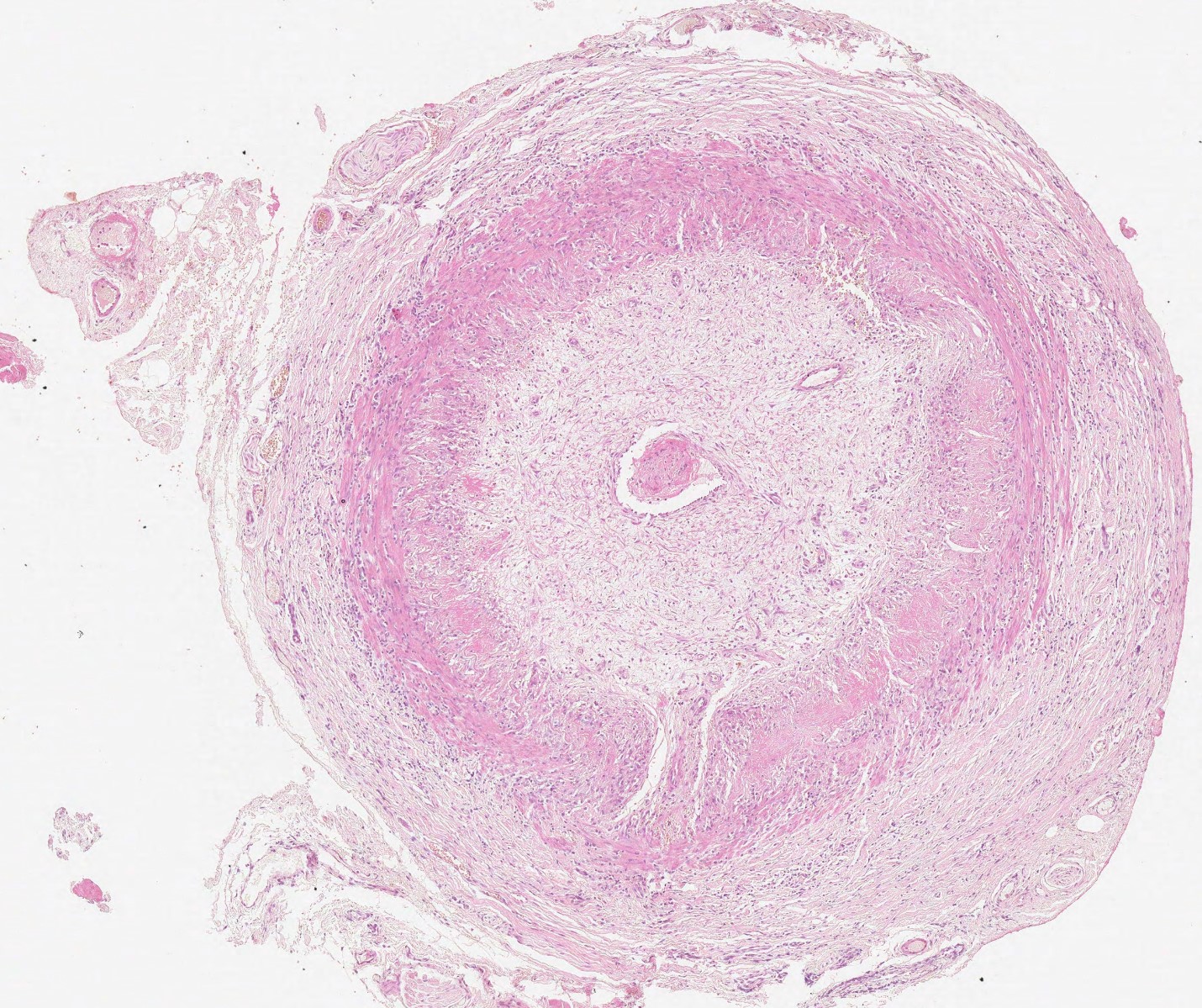 Neoangiogenesis