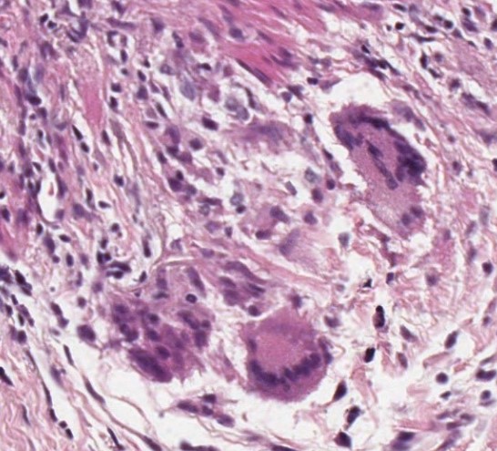 Multinucleated Giant Cells - GCA Histology